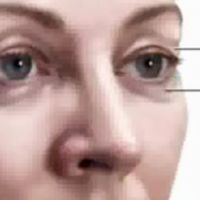 Блефаропластика вид коррекции глаз в пластической хирургии